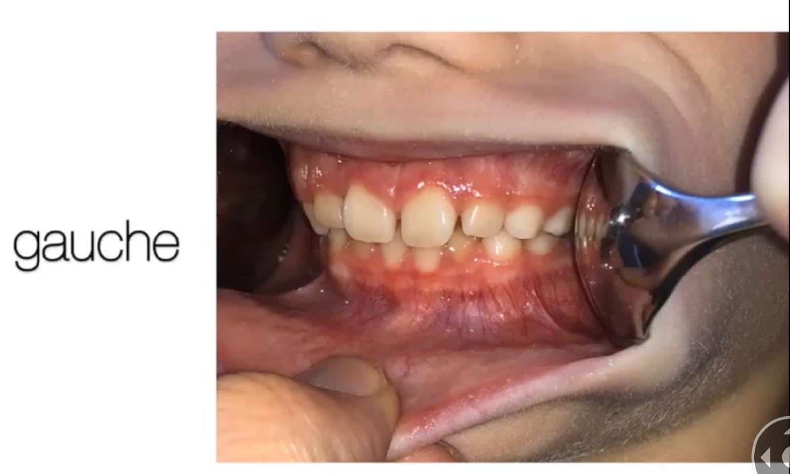 Docteur Samama Orthodontiste e-consultation dents de face orthodontiste Vesinet Boucle de seine Pecq Croissy Chatou Houille Montesson Marly Maison Laffitte invisalign